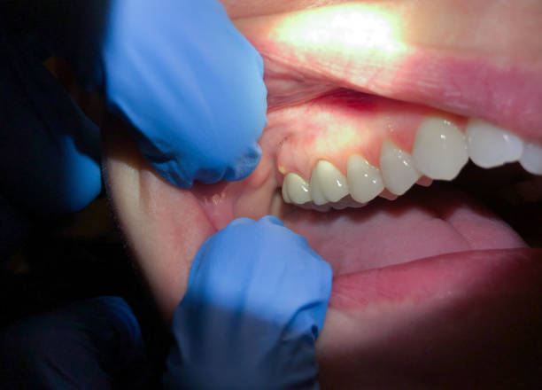 Best Emergency Root Canal Treatment in Byrnes Mill, MO